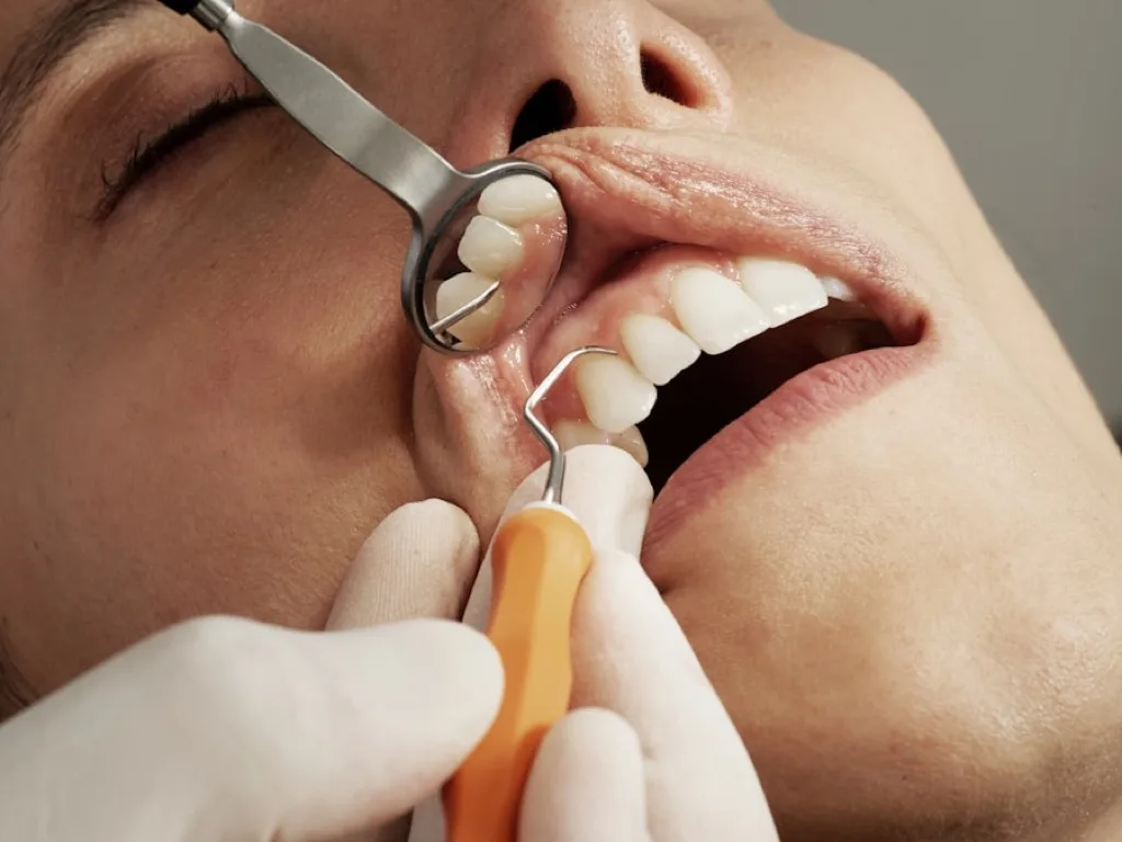 Hollywood Smile – Porcelain Veneers
